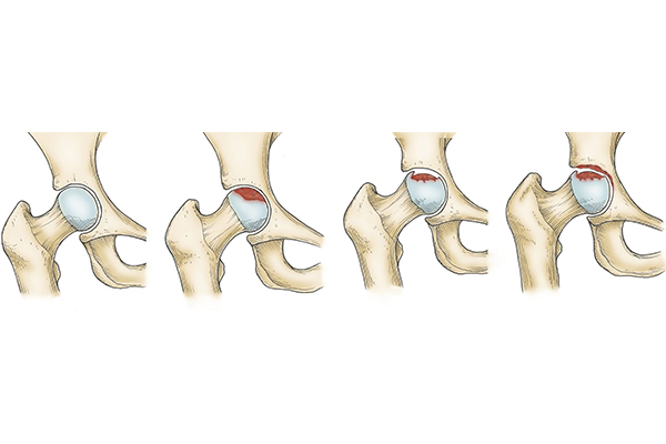 Femur Başı Avasküler Nekrozunda Bifosfanat Kullanımı