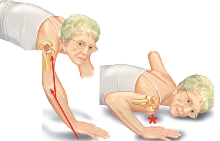 Erişkinlerde Humerus Üst Uç Kırıkları