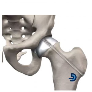 Çocuklarda Femur Başı Epifiz Kayması (FBEK)