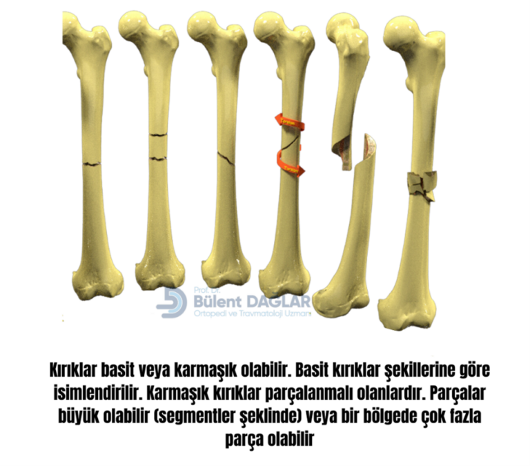 Kırık İyileşmesini Neler Etkiler?